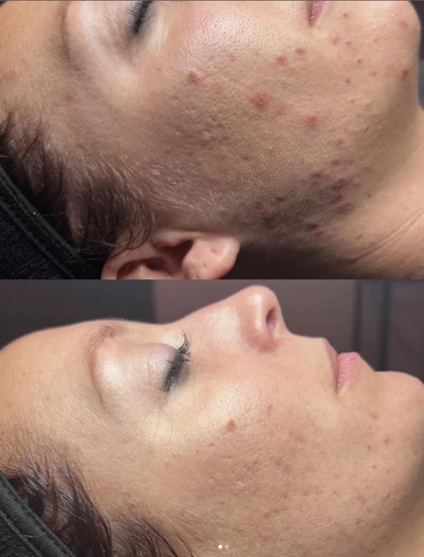 acne, Green sea peel, huidverbetering westland