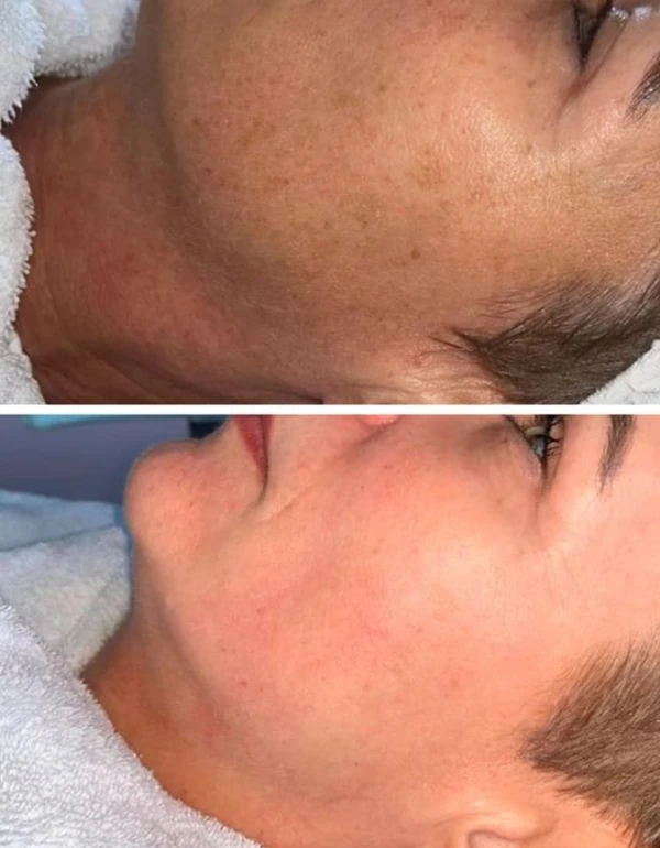 pigment verhelderen westland