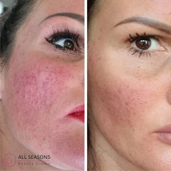 roodheid verminderen westland