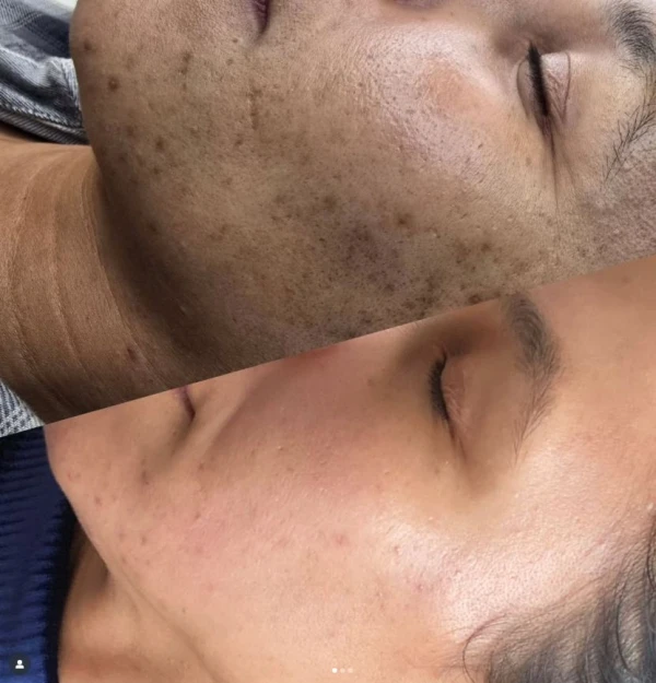 littekens verminderen westland